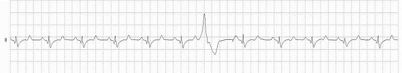 VEB Right Bundle Branch Morphology Rhythm Strip